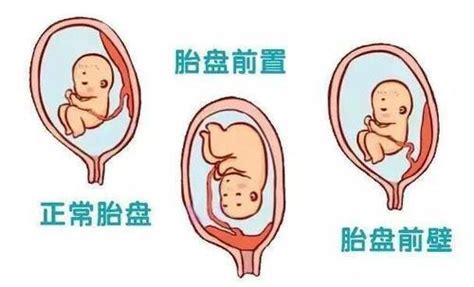 植入胎盤